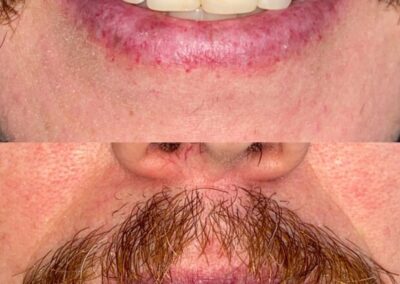 Blanqueamiento Dental costa rica 1