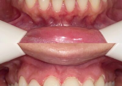Blanqueamiento Dental costa rica 10