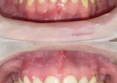 Blanqueamiento Dental costa rica 14
