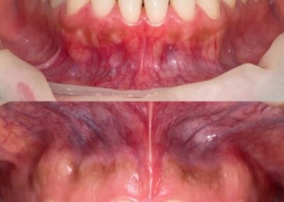 Blanqueamiento Dental costa rica 15