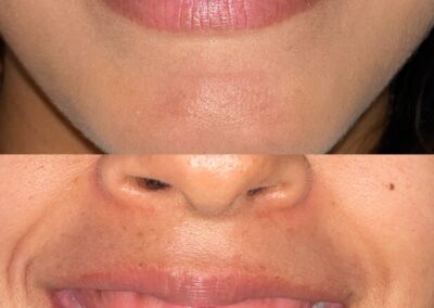 Blanqueamiento Dental costa rica 16