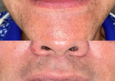 Blanqueamiento Dental costa rica 17