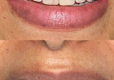 Blanqueamiento Dental costa rica 19