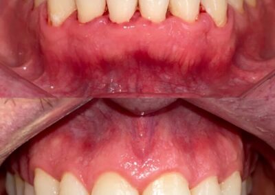 Blanqueamiento Dental costa rica 2