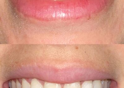 Blanqueamiento Dental costa rica 23
