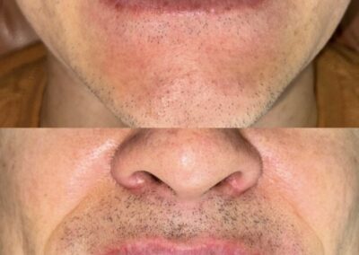 Blanqueamiento Dental costa rica 4