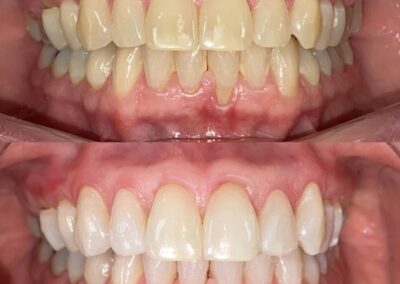 Blanqueamiento Dental costa rica 9
