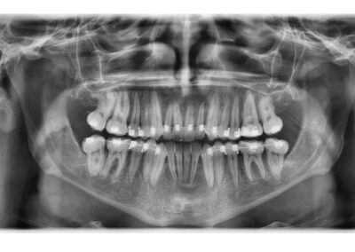 Caso Real Éxito Brackets Pitts 21 1