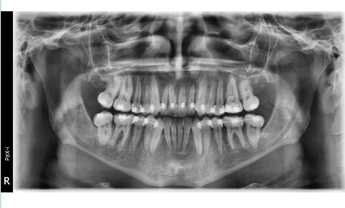 Caso Real Éxito Brackets Pitts 21 1