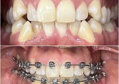 Caso Real Éxito Brackets Pitts 21 10