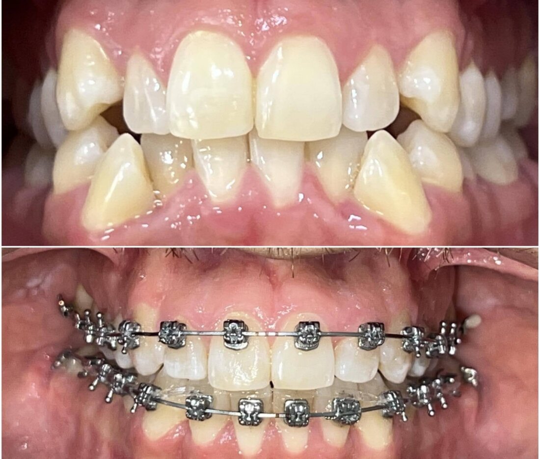 Caso Real Éxito Brackets Pitts 21 10