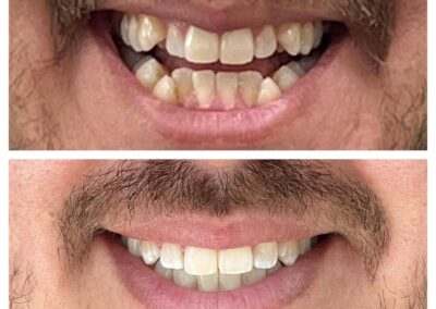 Caso Real Éxito Brackets Pitts 21 11
