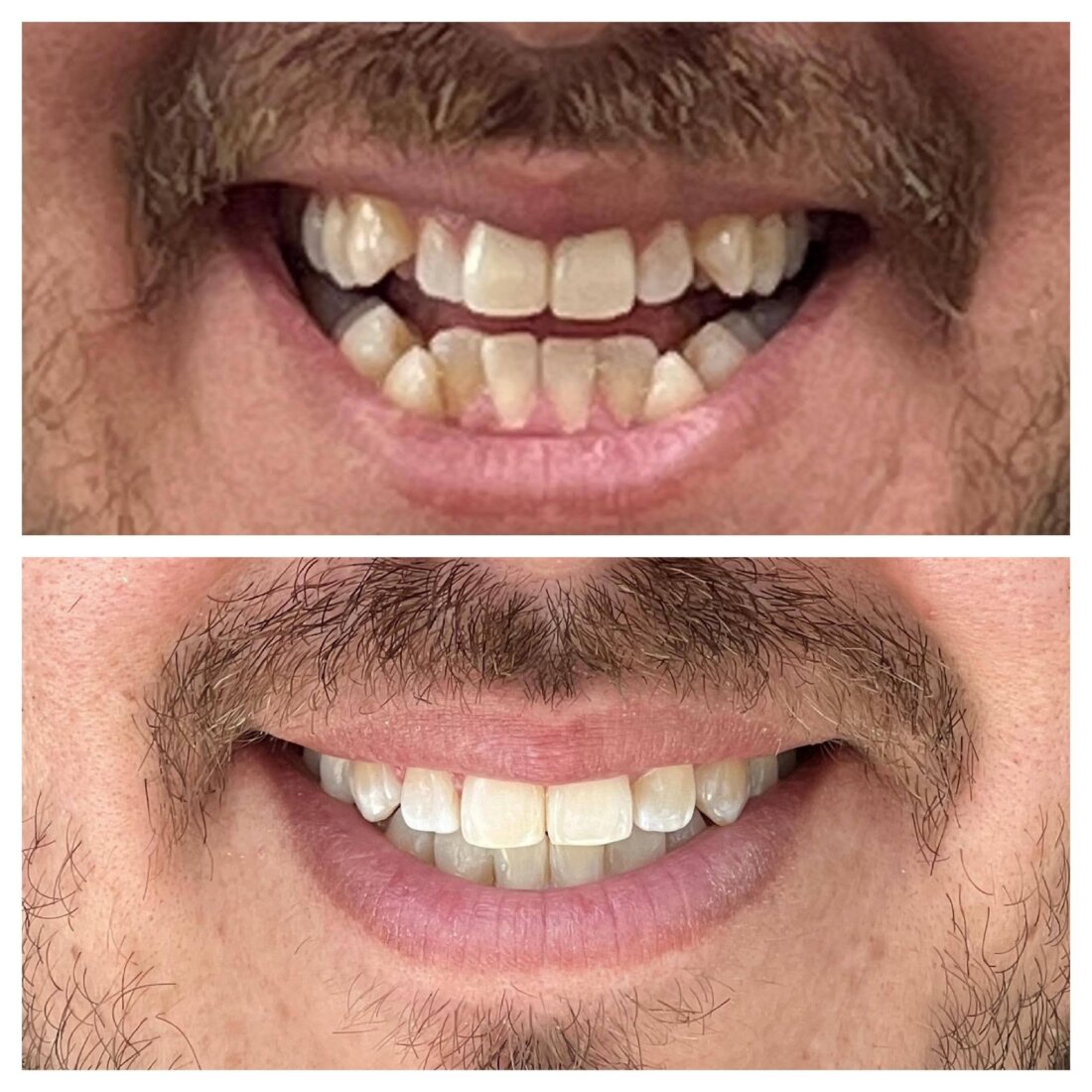 Caso Real Éxito Brackets Pitts 21 11