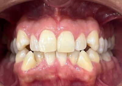 Caso Real Éxito Brackets Pitts 21 13