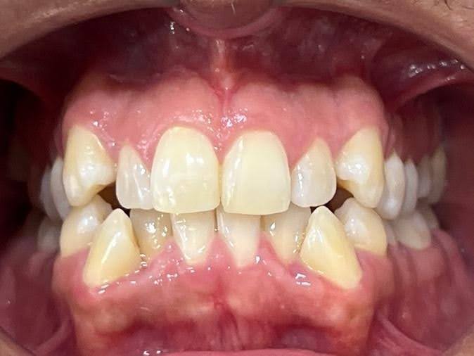 Caso Real Éxito Brackets Pitts 21 13