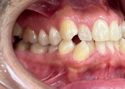 Caso Real Éxito Brackets Pitts 21 2