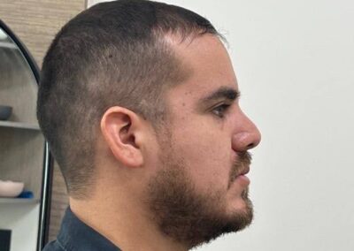 Caso Real Éxito Brackets Pitts 21 5