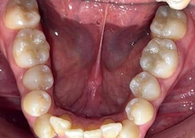Caso Real Éxito Brackets Pitts 21 6