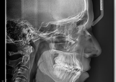 Caso Real Éxito Brackets Pitts 21 7