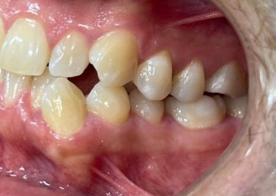 Caso Real Éxito Brackets Pitts 21 8