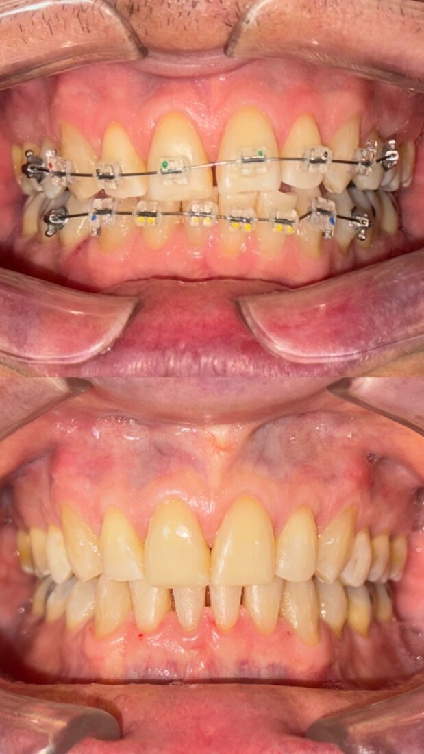 Ortodoncia Brackets costa rica 6