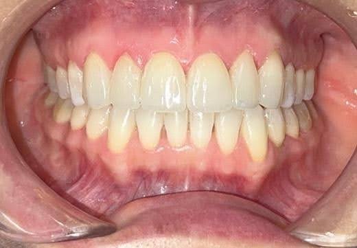 caso exito ortodoncia alineadores Invisalign 4
